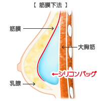 豊胸挿入位置