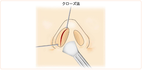 眉間プロテーゼの挿入方法