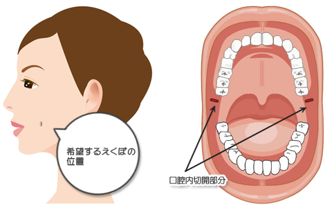 えくぼ形成 美容整形 美容外科のヴェリテクリニック 公式 東京 名古屋 大阪