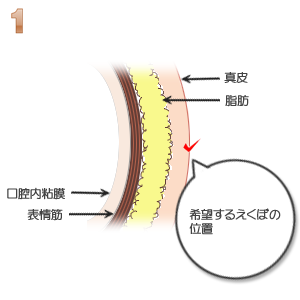 えくぼ形成