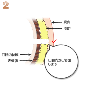 えくぼ形成