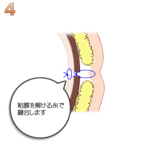 えくぼ形成