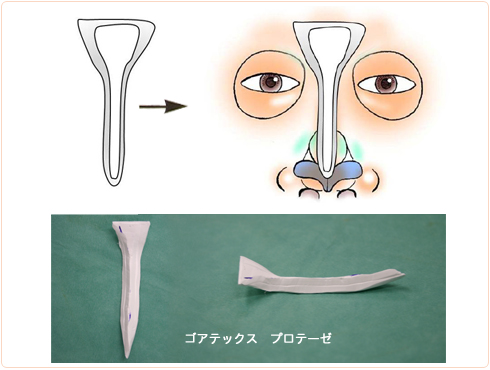 眉間プロテーゼのデザイン