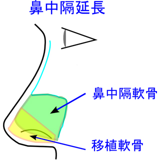 鼻中隔延長術