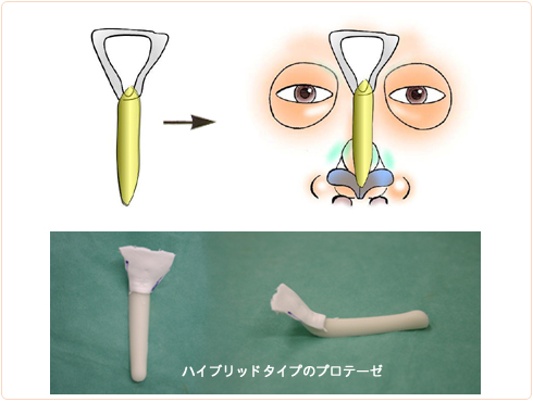 眉間プロテーゼのデザイン