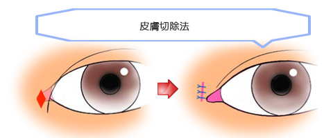 目頭切開：皮膚切除法