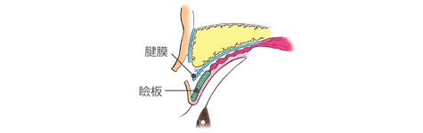 眼瞼下垂: 腱膜と瞼板