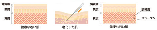 PRP療法