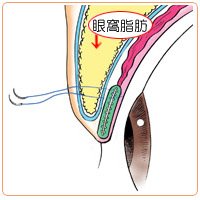 眼窩脂肪を切り取る脱脂術の効果