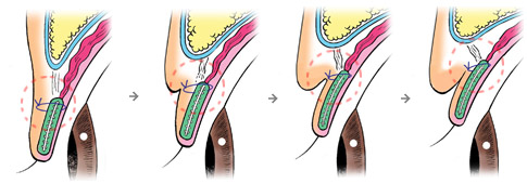 重瞼術の仕組み