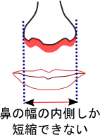 上口唇短縮術