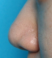 鼻翼