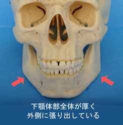 下顎体部が全体に外側に張り出し、角部はむしろ後内側へ回り込んでいるもの