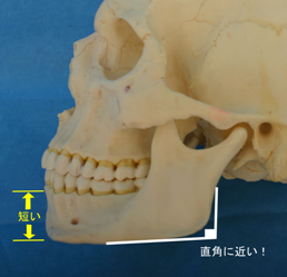 タイプⅡに加えてオトガイ部の垂直高が短いもの