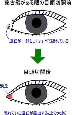 目尻切開やっても変らないって本当 美容整形 美容外科のヴェリテクリニック 公式 東京 名古屋 大阪