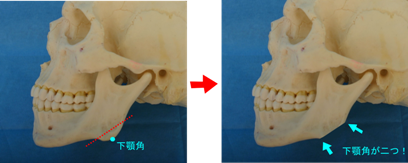 「下顎角」が二つ