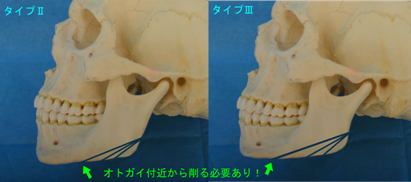 オトガイからほぼ下顎全体を削るイメージ