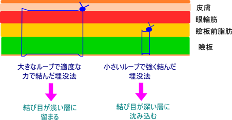 二重埋没法の力加減