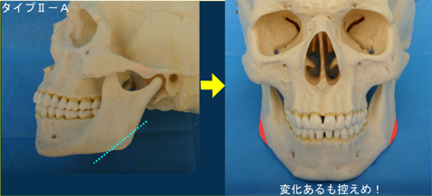 タイプⅡに加えてオトガイ部の垂直高が短いもの