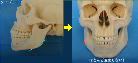 タイプⅡに加えてオトガイ部の垂直高が短いもの