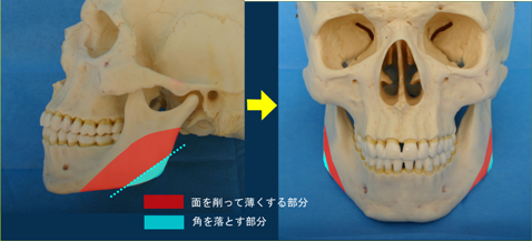 下顎角部に骨棘があり咬筋肥大を伴うもの