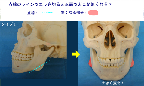 タイプⅡに加えてオトガイ部の垂直高が短いもの