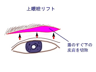 上眼瞼リフト