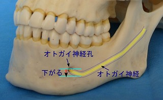 アゴ骨切り