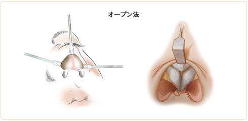 眉間プロテーゼの挿入方法