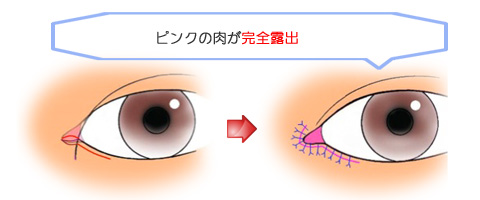 目頭切開：リドレープ法