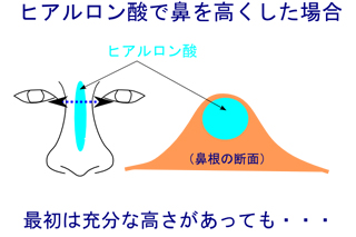 ヒアルロン酸