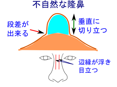 不自然な隆鼻術