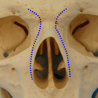 鼻骨骨切り