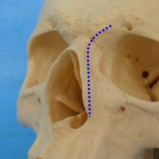 鼻骨骨切り