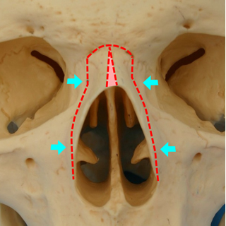 鼻骨骨切り