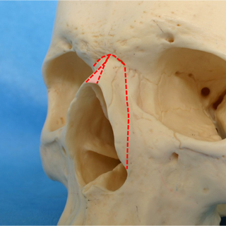 鼻骨骨切り