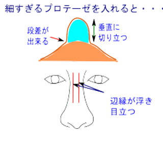 細すぎるプロテーゼ