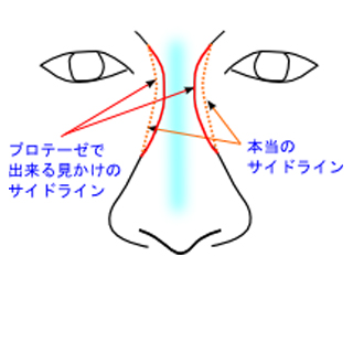 細すぎるプロテーゼ