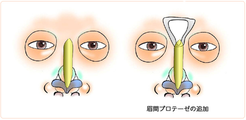 眉間プロテーゼが必要なわけ