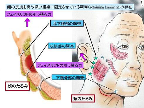 フェイスリフト