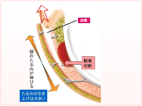 フェイスリフト