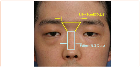 眉間プロテーゼのデザイン