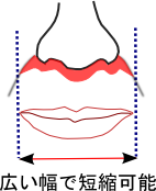 上口唇短縮術