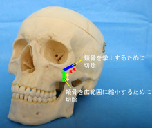 頬骨形成