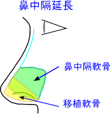 鼻中隔延長術