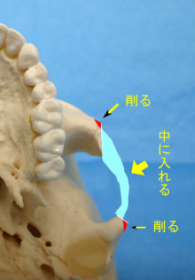 頬骨形成