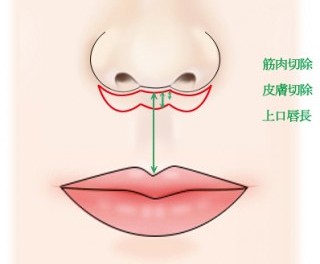 上口唇短縮