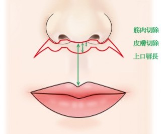 上口唇短縮