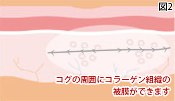 コラーゲン組織の被膜ができます