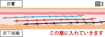 糸の挿入イメージ